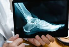 Orthopedic surgeons performing a joint replacement procedure in a hospital operating room